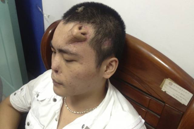 Nose grows on man's forehead- medical breakthrough