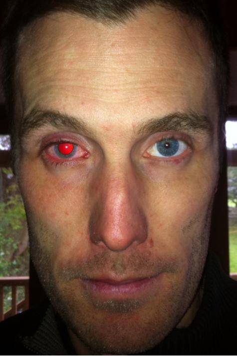 Torn my cornea but on the plus side I look like the Terminator