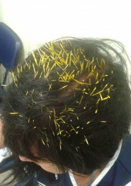 A porcupine fell from a tree and fell on her head... The apex of unluckiness.