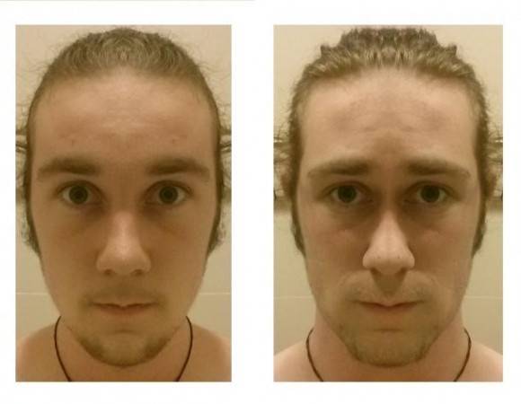 No ones face is symmetrical. These are the two halves of my face.