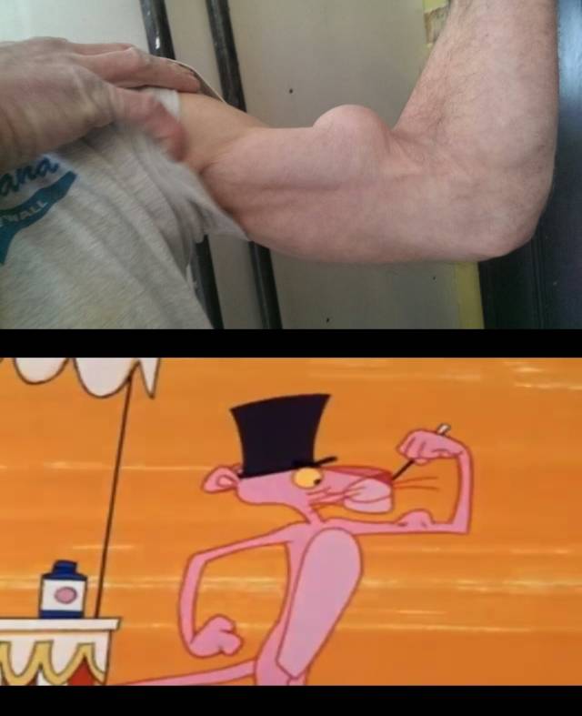 I knew I'd seen that strange arm bulge somewhere before.