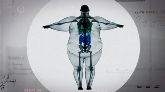 X-ray of a 900 pound man