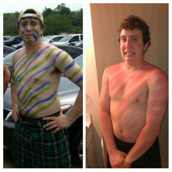 Warrior Forgot His Sunscreen
