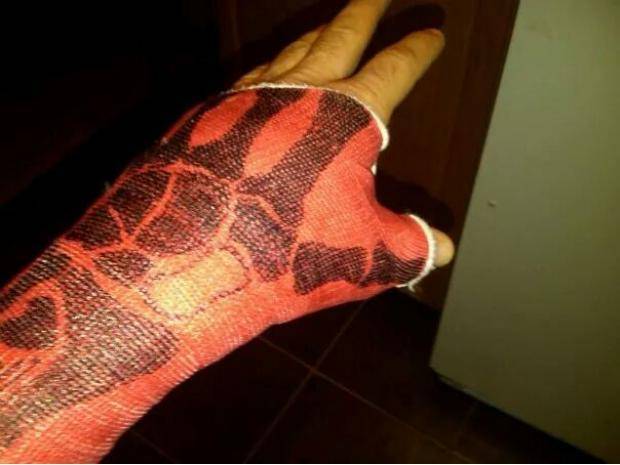 I got bored and drew the bones on my cast, I left one blank so I could easily show people which one I broke when they asked what happened.