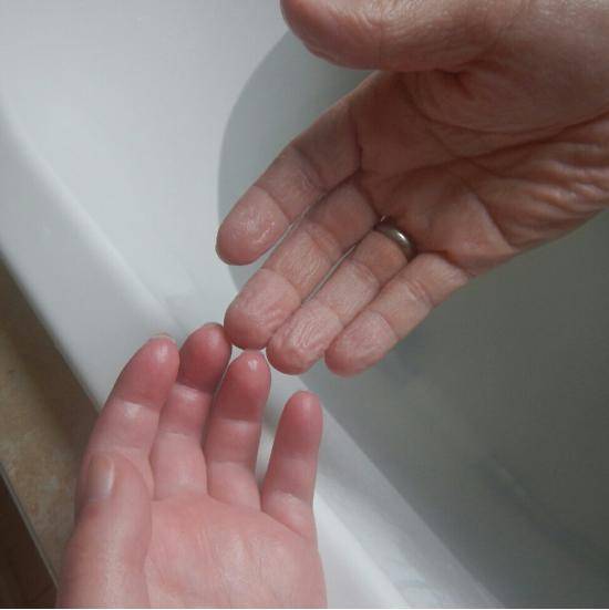 My hands after 20 minutes in the bath, left one (paralysed) no wrinkles