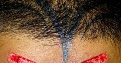 15 Most Extreme Scarification Tattoos (NSFW)