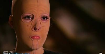 After Almost Three Long Years, This Burns Victim Got Her Mask Removed.. What Happened Next Will Shock You!