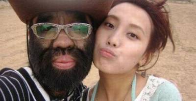 The Hairiest Man of China, Yu Zhenhuan Undertakes Laser Hair Removal Treatment