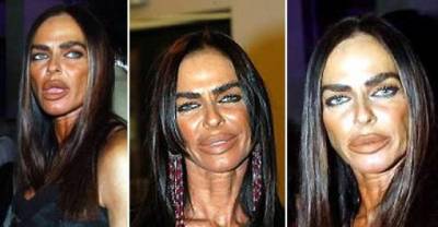 The Worst Plastic Surgery Disasters EVER!