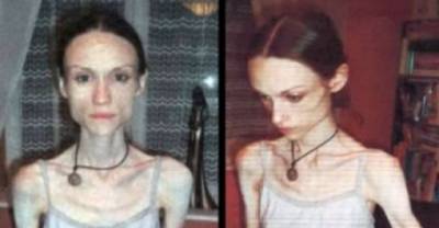 Some of the Most Shocking Cases of Anorexia Ever Seen