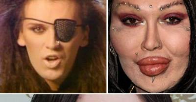 Plastic Surgery Fails: 8 Lip Enhancements Gone Wrong