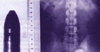 10 Craziest Foreign Objects Found Stuck In A Rectum