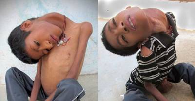 'We&rsquo;d rather he were dead than suffering like this', say parents of 12-year-old Indian boy whose head hangs at a 180-degree angle due to a rare condition.