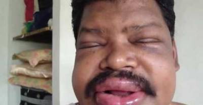 16 Images Of People Having Extreme Allergic Reactions