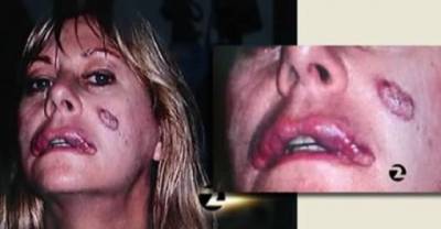 5 Beauty Surgeries Gone Terribly Wrong