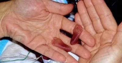 8 Newborns Who Survived the Impossible #7 Will Bring Tears In Your Eyes