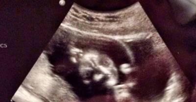 These Sonograms Are Supposed To Look Like Babies, But Definitely...Don't.