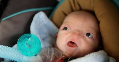 Baby Born Without Nose Is Very Cute