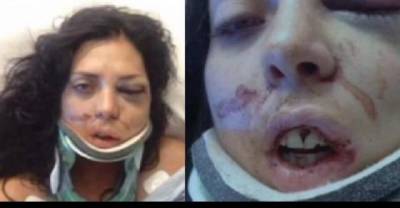 Woman Suing Police After Officers Slam Her To The Ground Breaking 4 Bones In Her Face