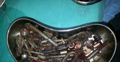 What Doctors Found In This Man's Stomach Doesn't Seem Medically Possible