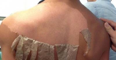 Terrible Sunburns That Are Painful To Look At