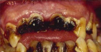 The Horrors Of Meth Mouth - 17 Pics