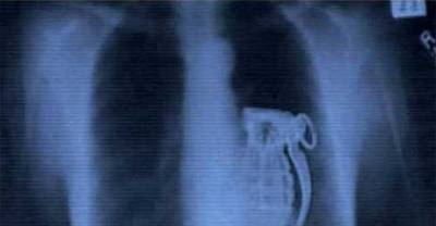 17 Of The Most Unbelievable Items Surgeons Have Yanked Out of People #4 is Hilarious!