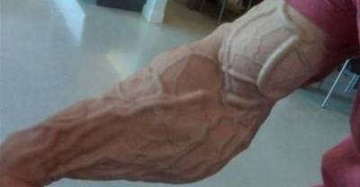 10 People Who Suffered From High Steroid Intake