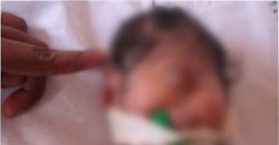 Baby Born With One Eye (NFSW)