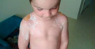 Two Little Boys Suffer Horrific Sunburn At Day Care And Their Mother Has Shared Their Pain Online (GRAPHIC IMAGES)
