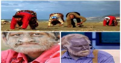 18 Unusual Genetic Conditions You Probably Don't Know Existed