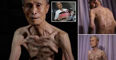 This Man was 16 When Nuclear Bomb Exploded In Japan. 70-Years Later He Tells The Story Of His Still Hurting Wounds