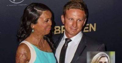 This Australian Ex-Model Suffered Burns To 65 Per Cent Of Her Body, You'll Never Guess What Her Husbands Response Was. It's Very Touching.