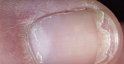 What Nails Can Tell You About Your Health You Can&rsquo;t Even Imagine