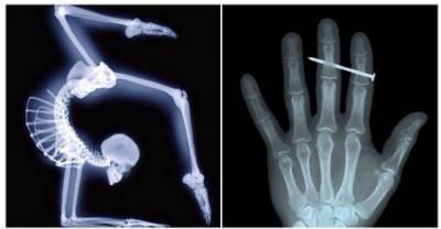 Graphic X-Rays That Are So Shocking You Won't Believe The Patients Survived!