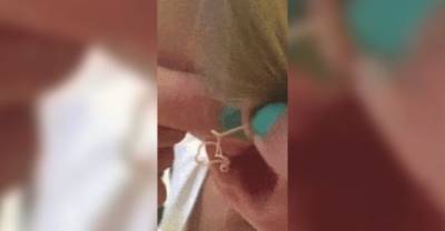 Girl Finally Pops Enormous 6-Year-Old Pimple On Her Ear