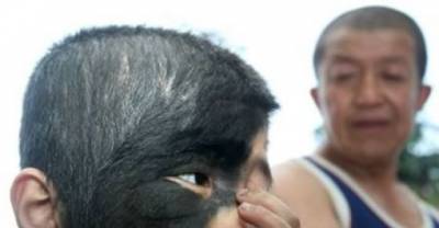 10 Of The Strangest Birthmarks Ever Recorded.