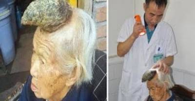 Chinese &ldquo;Unicorn Woman&rdquo; Has 5-inch Horn Growing From Her Head