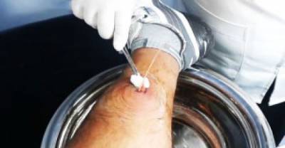 Guy Gets Nasty 3 Year Old Cyst On His Leg Popped