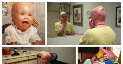 A Woman With A Rare Skin Condition Is The First With Her Condition In The World To Give Birth