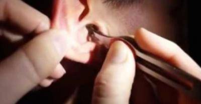 A Family Of Cockroaches Was Living Inside This Guy's Ears