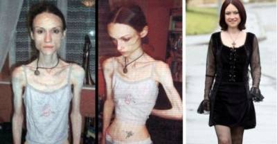 15 Inspiring Before And After Pictures Of People Who Beat Their Eating Disorders