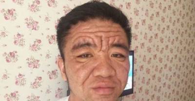 Strange Condition Causes 30-Year-Old Man to Look Decades Older