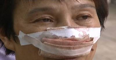 'My husband bit my nose off and ATE it because I didn't answer his phone call': Chinese woman tells of her terrible ordeal with estranged spouse