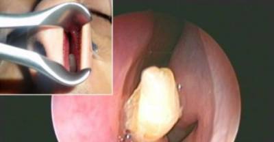 Unbelievable! A Random Tooth Was Found Growing In This Man's Nose