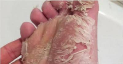 Her Foot Was Dying But When She Pulled Her Skin.. Horrifying!