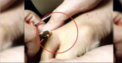 What They Removed From This Man&rsquo;s Foot Will Make You Bleach Your Eyeballs. Eww.