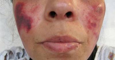 Cocaine Can Rot Flesh And Turn Ears Black - And This Is Why