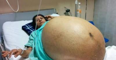 Terrifying! The Story Mexican Women Whose Weight Increased To 275 Pounds With A 132 Pound Of Tumor