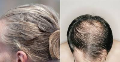 Man Buns Are Making Men Go Bald